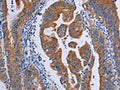 The image on the left is immunohistochemistry of paraffin-embedded Human gastic cancer tissue using CSB-PA196351(ACP6 Antibody) at dilution 1/50, on the right is treated with fusion protein. (Original magnification: ×200)