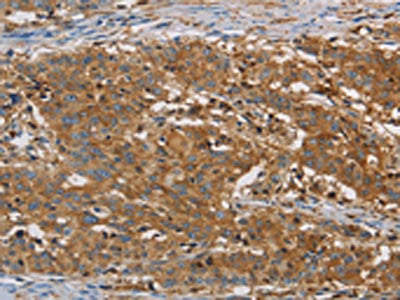 The image is immunohistochemistry of paraffin-embedded Human gastic cancer tissue using CSB-PA196408(CFL1 Antibody) at dilution 1/30. (Original magnification: 200)