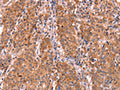 The image on the left is immunohistochemistry of paraffin-embedded Human gastic cancer tissue using CSB-PA196653(ABI1 Antibody) at dilution 1/40, on the right is treated with synthetic peptide. (Original magnification: ×200)