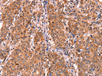 The image on the left is immunohistochemistry of paraffin-embedded Human gastic cancer tissue using CSB-PA196653(ABI1 Antibody) at dilution 1/40, on the right is treated with synthetic peptide. (Original magnification: ×200)