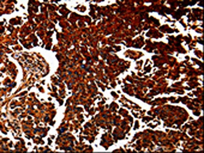 The image is immunohistochemistry of paraffin-embedded Human lung cancer tissue using CSB-PA196764(ANXA7 Antibody) at dilution 1/40. (Original magnification: ×200)
