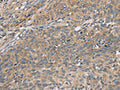 The image on the left is immunohistochemistry of paraffin-embedded Human cervical cancer tissue using CSB-PA196852(CST2 Antibody) at dilution 1/50, on the right is treated with fusion protein. (Original magnification: ×200)