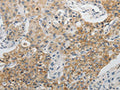 The image on the left is immunohistochemistry of paraffin-embedded Human lung cancer tissue using CSB-PA196946(CDH3 Antibody) at dilution 1/5, on the right is treated with fusion protein. (Original magnification: ×200)