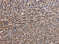 The image on the left is immunohistochemistry of paraffin-embedded Human sarcoma tissue using CSB-PA197107(KIF2A Antibody) at dilution 1/30, on the right is treated with fusion protein. (Original magnification: ×200)