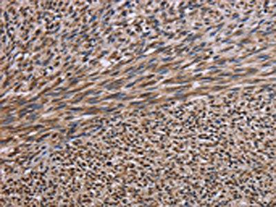 The image on the left is immunohistochemistry of paraffin-embedded Human sarcoma tissue using CSB-PA197107(KIF2A Antibody) at dilution 1/30, on the right is treated with fusion protein. (Original magnification: ×200)