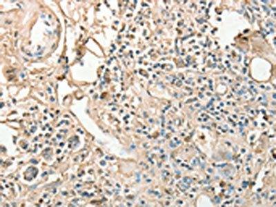 The image on the left is immunohistochemistry of paraffin-embedded Human gastric cancer tissue using CSB-PA197217(AGBL2 Antibody) at dilution 1/25, on the right is treated with fusion protein. (Original magnification: ×200)