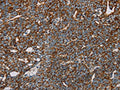 The image on the left is immunohistochemistry of paraffin-embedded Human cervical cancer tissue using CSB-PA197280(NDUFS3 Antibody) at dilution 1/30, on the right is treated with fusion protein. (Original magnification: ×200)