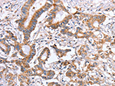 The image on the left is immunohistochemistry of paraffin-embedded Human colon cancer tissue using CSB-PA197500(ITGB5 Antibody) at dilution 1/25, on the right is treated with fusion protein. (Original magnification: ×200)