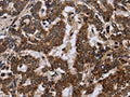 The image on the left is immunohistochemistry of paraffin-embedded Human liver cancer tissue using CSB-PA197834(FIS1 Antibody) at dilution 1/20, on the right is treated with fusion protein. (Original magnification: ×200)