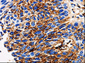 The image on the left is immunohistochemistry of paraffin-embedded Human lung cancer tissue using CSB-PA198249(ADAMTS5 Antibody) at dilution 1/10, on the right is treated with synthetic peptide. (Original magnification: ×200)
