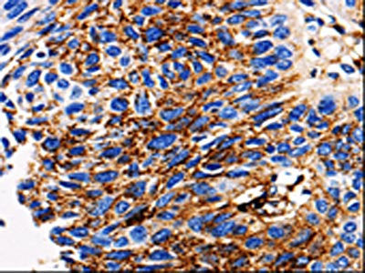 The image on the left is immunohistochemistry of paraffin-embedded Human lung cancer tissue using CSB-PA198249(ADAMTS5 Antibody) at dilution 1/10, on the right is treated with synthetic peptide. (Original magnification: ×200)