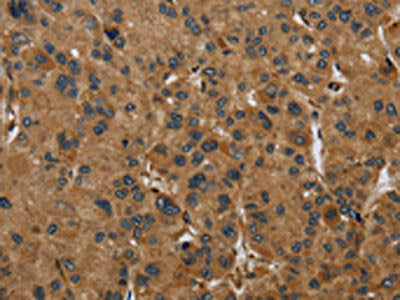 The image on the left is immunohistochemistry of paraffin-embedded Human liver cancer tissue using CSB-PA198597(PAEP Antibody) at dilution 1/60, on the right is treated with fusion protein. (Original magnification: ×200)