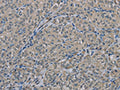 The image on the left is immunohistochemistry of paraffin-embedded Human thyroid cancer tissue using CSB-PA198612(EDN1 Antibody) at dilution 1/30, on the right is treated with fusion protein. (Original magnification: ×200)