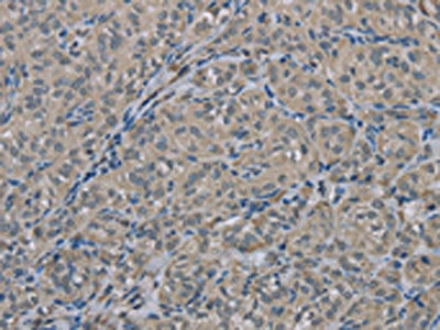The image on the left is immunohistochemistry of paraffin-embedded Human thyroid cancer tissue using CSB-PA198612(EDN1 Antibody) at dilution 1/30, on the right is treated with fusion protein. (Original magnification: ×200)