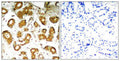 Immunohistochemical analysis of paraffin-embedded human breast carcinoma tissue using NFkB-p65(Ab-505) Antibody(left) or the same antibody preincubated with blocking peptide(right).