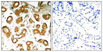 Immunohistochemical analysis of paraffin-embedded human breast carcinoma tissue using NFkB-p65(Ab-505) Antibody(left) or the same antibody preincubated with blocking peptide(right).