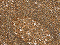 The image on the left is immunohistochemistry of paraffin-embedded Human tonsil tissue using CSB-PA198930(SLC6A3 Antibody) at dilution 1/50, on the right is treated with synthetic peptide. (Original magnification: ×200)
