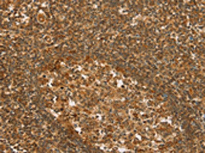The image on the left is immunohistochemistry of paraffin-embedded Human tonsil tissue using CSB-PA198930(SLC6A3 Antibody) at dilution 1/50, on the right is treated with synthetic peptide. (Original magnification: ×200)