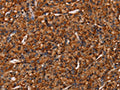 The image on the left is immunohistochemistry of paraffin-embedded Human prostate cancer tissue using CSB-PA199023(COL18A1 Antibody) at dilution 1/40, on the right is treated with synthetic peptide. (Original magnification: ×200)