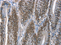 The image on the left is immunohistochemistry of paraffin-embedded Human colon cancer tissue using CSB-PA199057(GNRH1 Antibody) at dilution 1/65, on the right is treated with fusion protein. (Original magnification: ×200)