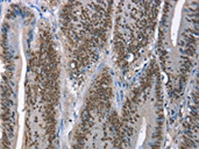 The image on the left is immunohistochemistry of paraffin-embedded Human colon cancer tissue using CSB-PA199057(GNRH1 Antibody) at dilution 1/65, on the right is treated with fusion protein. (Original magnification: ×200)