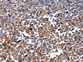 The image on the left is immunohistochemistry of paraffin-embedded Human ovarian cancer tissue using CSB-PA199595(HSPD1 Antibody) at dilution 1/15, on the right is treated with fusion protein. (Original magnification: ×200)