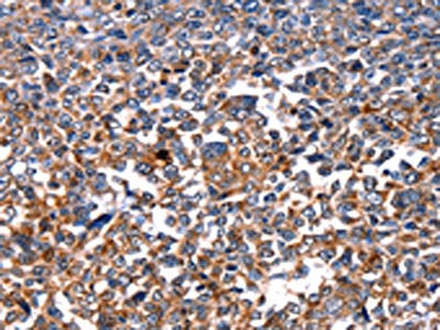 The image on the left is immunohistochemistry of paraffin-embedded Human ovarian cancer tissue using CSB-PA199595(HSPD1 Antibody) at dilution 1/15, on the right is treated with fusion protein. (Original magnification: ×200)