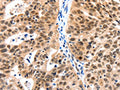 The image on the left is immunohistochemistry of paraffin-embedded Human ovarian cancer tissue using CSB-PA200092(LRP5 Antibody) at dilution 1/115, on the right is treated with synthetic peptide. (Original magnification: ×200)