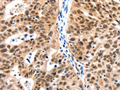 The image on the left is immunohistochemistry of paraffin-embedded Human ovarian cancer tissue using CSB-PA200092(LRP5 Antibody) at dilution 1/115, on the right is treated with synthetic peptide. (Original magnification: ×200)