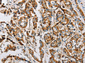 The image on the left is immunohistochemistry of paraffin-embedded Human breast cancer tissue using CSB-PA200236(IFITM3 Antibody) at dilution 1/25, on the right is treated with fusion protein. (Original magnification: ×200)