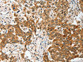 The image on the left is immunohistochemistry of paraffin-embedded Human esophagus cancer tissue using CSB-PA200381(BNIP1 Antibody) at dilution 1/30, on the right is treated with fusion protein. (Original magnification: ×200)