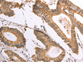 The image on the left is immunohistochemistry of paraffin-embedded Human colon cancer tissue using CSB-PA200625(NAMPT Antibody) at dilution 1/30, on the right is treated with fusion protein. (Original magnification: ×200)