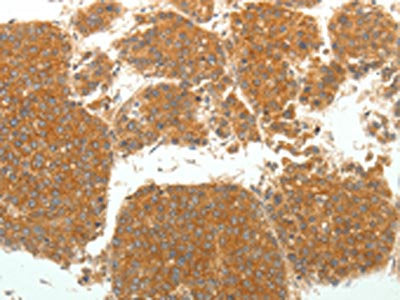 The image on the left is immunohistochemistry of paraffin-embedded Human liver cancer tissue using CSB-PA201090(SIRT4 Antibody) at dilution 1/25. (Original magnification: ×200)