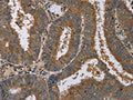The image on the left is immunohistochemistry of paraffin-embedded Human colon cancer tissue using CSB-PA201270(DNAJA1 Antibody) at dilution 1/60, on the right is treated with fusion protein. (Original magnification: ×200)