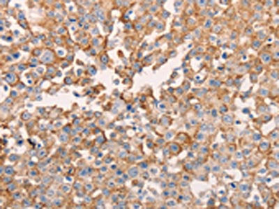 The image on the left is immunohistochemistry of paraffin-embedded Human breast cancer tissue using CSB-PA201320(GNA11 Antibody) at dilution 1/40, on the right is treated with fusion protein. (Original magnification: ×200)