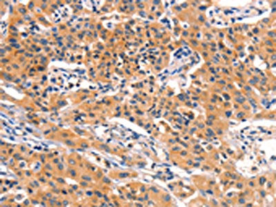 The image on the left is immunohistochemistry of paraffin-embedded Human lung cancer tissue using CSB-PA201757(AMY2A Antibody) at dilution 1/50, on the right is treated with fusion protein. (Original magnification: ×200)