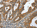 The image on the left is immunohistochemistry of paraffin-embedded Human gastic cancer tissue using CSB-PA201854(COL1A2 Antibody) at dilution 1/20, on the right is treated with fusion protein. (Original magnification: ×200)