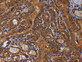 The image on the left is immunohistochemistry of paraffin-embedded Human thyroid cancer tissue using CSB-PA202304(MAGEB10 Antibody) at dilution 1/60, on the right is treated with fusion protein. (Original magnification: ×200)