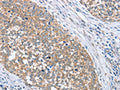 The image on the left is immunohistochemistry of paraffin-embedded Human cervical cancer tissue using CSB-PA203103(PAPSS1 Antibody) at dilution 1/40, on the right is treated with fusion protein. (Original magnification: ×200)