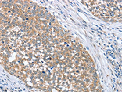 The image on the left is immunohistochemistry of paraffin-embedded Human cervical cancer tissue using CSB-PA203103(PAPSS1 Antibody) at dilution 1/40, on the right is treated with fusion protein. (Original magnification: ×200)