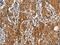 The image on the left is immunohistochemistry of paraffin-embedded Human gastic cancer tissue using CSB-PA203218(BGN Antibody) at dilution 1/50, on the right is treated with fusion protein. (Original magnification: ×200)