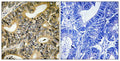 Immunohistochemical analysis of paraffin-embedded human colon carcinoma tissue using 4E-BP1 (Phospho-Thr70) antibody (left)or the same antibody preincubated with blocking peptide (right).
