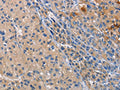 The image on the left is immunohistochemistry of paraffin-embedded Human liver cancer tissue using CSB-PA204342(CD207 Antibody) at dilution 1/40, on the right is treated with fusion protein. (Original magnification: x200)
