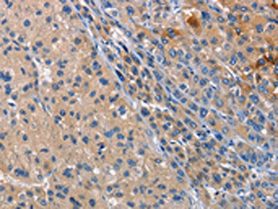 The image on the left is immunohistochemistry of paraffin-embedded Human liver cancer tissue using CSB-PA204342(CD207 Antibody) at dilution 1/40, on the right is treated with fusion protein. (Original magnification: x200)
