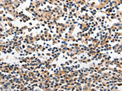 The image on the left is immunohistochemistry of paraffin-embedded Human tonsil tissue using CSB-PA204522(INHA Antibody) at dilution 1/120, on the right is treated with fusion protein. (Original magnification: ×200)