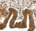 Immunohistochemical analysis of paraffin-embedded Human colon cancer tissue using at dilution 1/15.