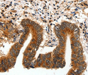 Immunohistochemical analysis of paraffin-embedded Human colon cancer tissue using at dilution 1/15.