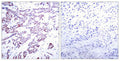 Immunohistochemical analysis of paraffin-embedded human breast carcinoma tissue using STAT6(Phospho-Thr645) Antibody(left) or the same antibody preincubated with blocking peptide(right).