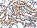 The image on the left is immunohistochemistry of paraffin-embedded Human thyroid cancer tissue using CSB-PA205006(TLR2 Antibody) at dilution 1/30, on the right is treated with fusion protein. (Original magnification: ×200)