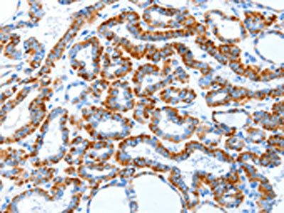 The image on the left is immunohistochemistry of paraffin-embedded Human thyroid cancer tissue using CSB-PA205006(TLR2 Antibody) at dilution 1/30, on the right is treated with fusion protein. (Original magnification: ×200)